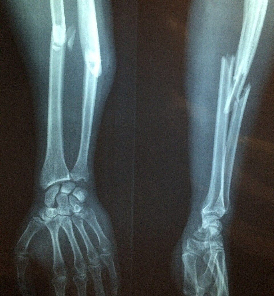 Imagen referencial de fractura. Foto: Pixabay.