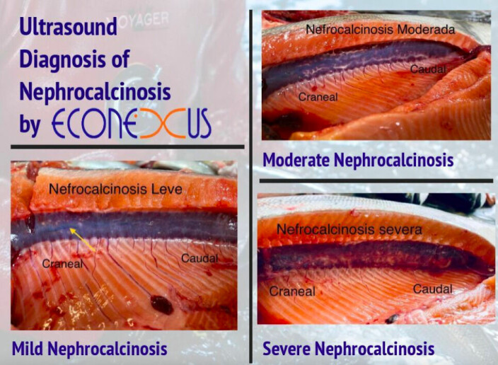 Categorización de la nefrocalcinosis.
